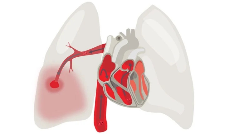 Complications after pulmonary embolism treatment