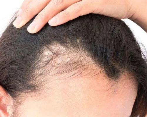 What is coin hair loss? Primary symptoms, treatment methods and risks