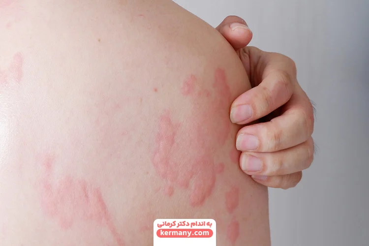 آیا کبد چرب باعث خارش بدن می شود؟