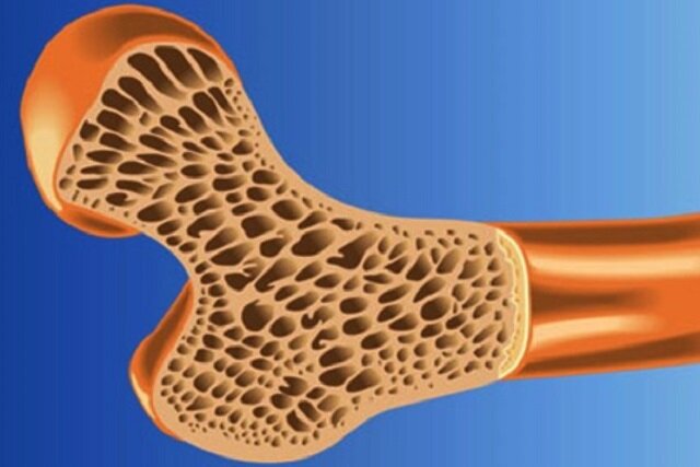 پوکی استخوان در نیمی از جمعیت کشور / وضعیت دستگاه‌های سنجش تراکم استخوان